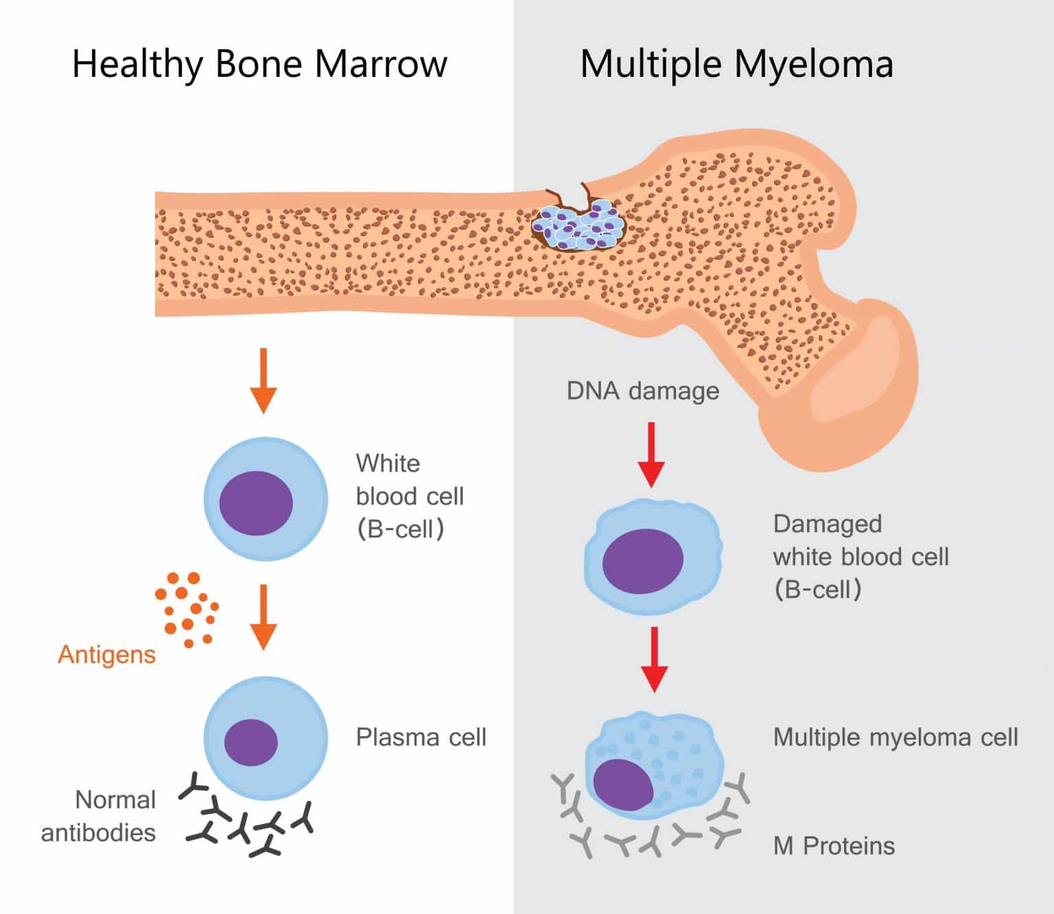 march-is-multiple-myeloma-awareness-month-cancer-exercise-training